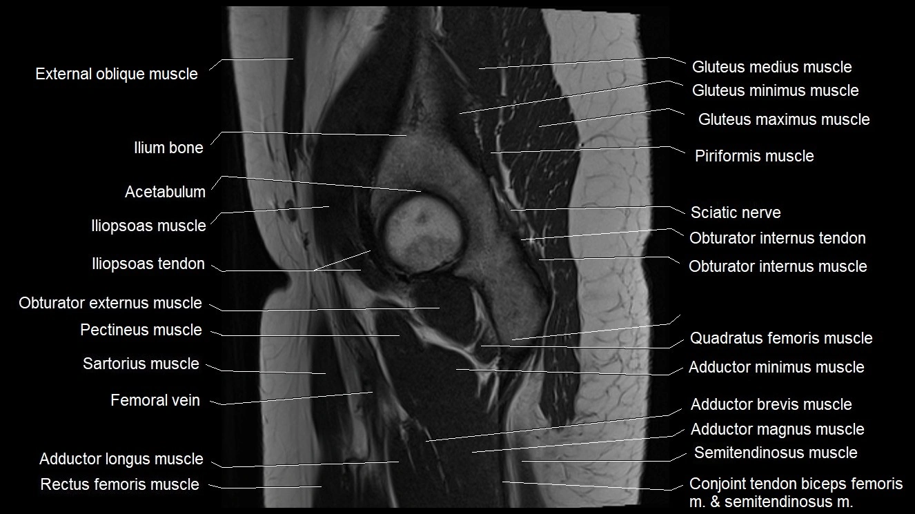 Hip sagittal cross sectional anatomy image 21.webp